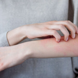 uzmani acikladi o belirtiler uyuz habercisi olabilir lKgL5ltk