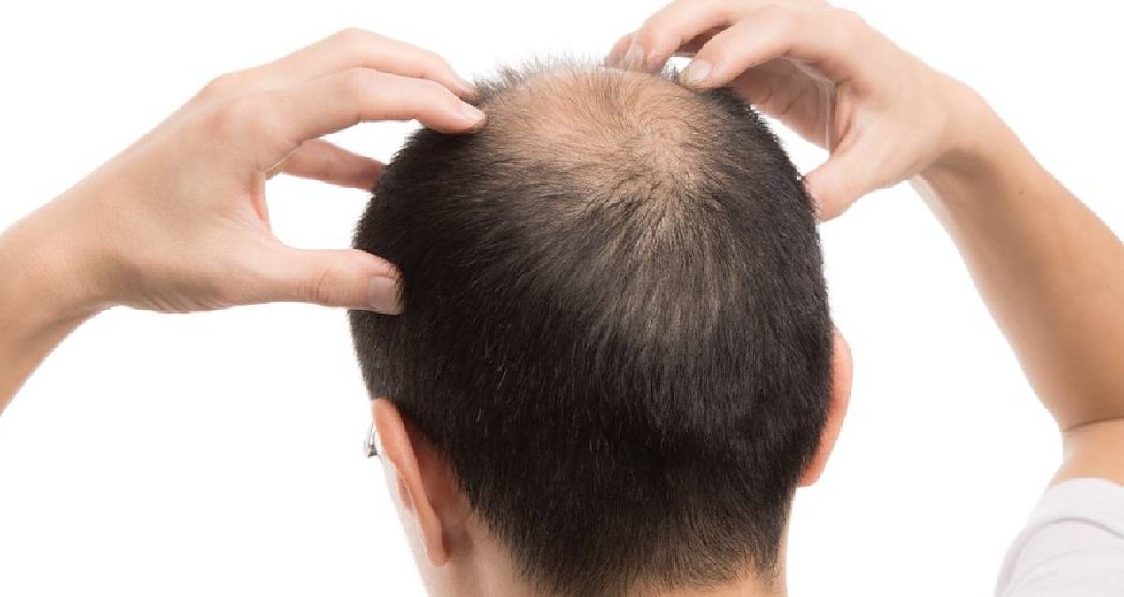 sac dokulmesini engelliyor kellik tarihe karisiyor 5jXt2k3A